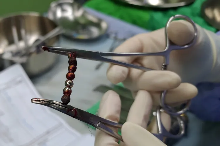 經由微創手術成功取出男童腸道內的巴克球。輔大醫院提供