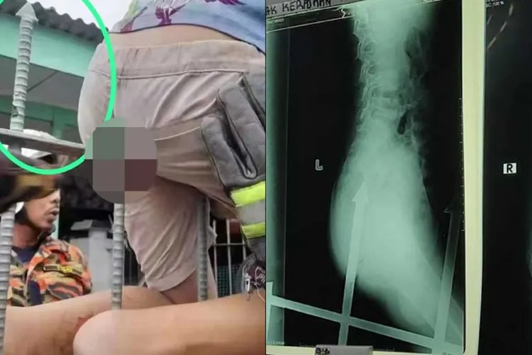 男童被籬笆尖刺刺入臀部痛到哀號。取自中國報