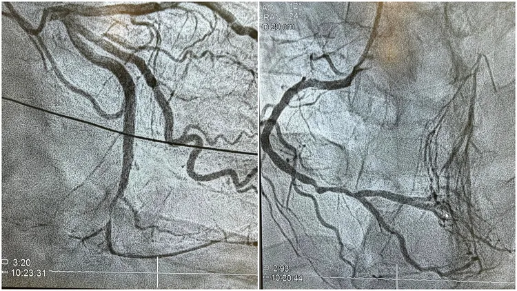 陳冠任醫師表示，患者輕忽膽固醇問題，心臟血管嚴重堵塞。翻攝臉書粉專「冠任醫師的異想世界」