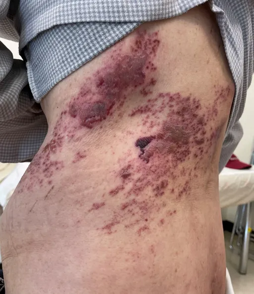 長皮蛇全身水泡又爆痛　北榮發現：糖尿病「這藥物」是利器！