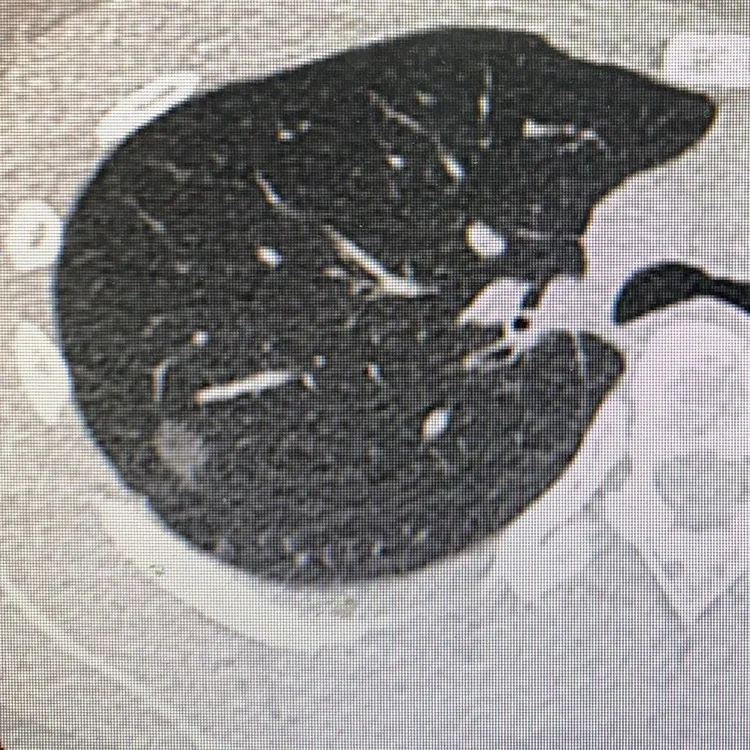 雅薇說，自費加做低劑量肺部電腦斷層（LDCT)，做完當下自己用電腦看到一顆充滿敵意的結節。翻攝自IG vivi_ocean