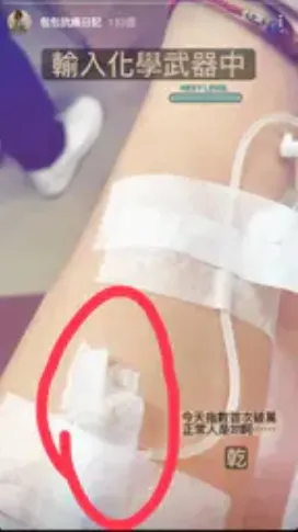 麵包包根本沒罹癌，卻假裝化療還PO照取暖賺流量。翻攝自論壇Dcard