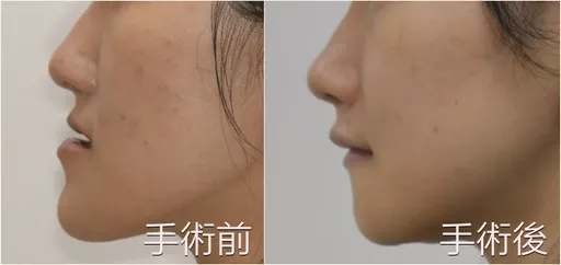 22岁「厚道」女求职不顺 美观线突出1.5公分!正颚手术助迎职场春天