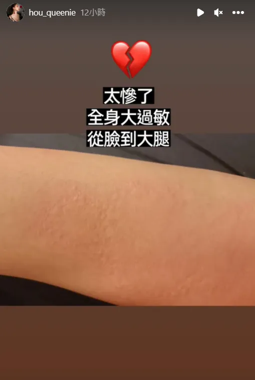 長瀨昆妮從臉到大腿都大過敏。翻攝自長瀨昆妮臉書