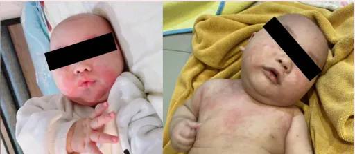 台灣每10童就1人異位皮膚炎 醫籲放寬用藥限制