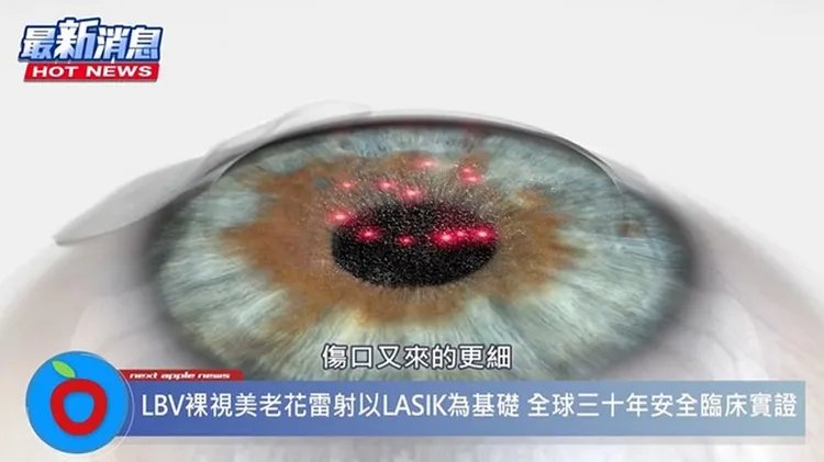 全新的「LBV裸視美老花熟齡雷射」效果好安全性高。
