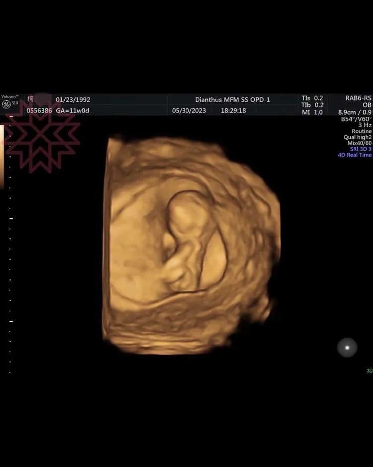 超音波左上角有媽媽的資訊。翻攝自楊繡惠IG
