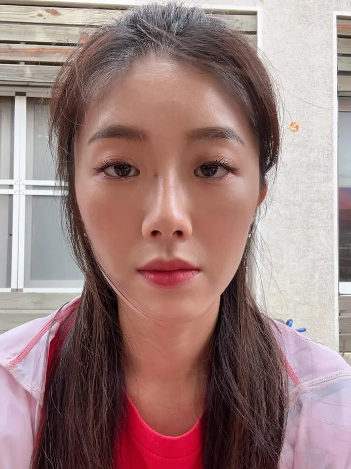 曾甜尚未開始治療時，眼睛完全無力張開。翻攝自曾甜臉書