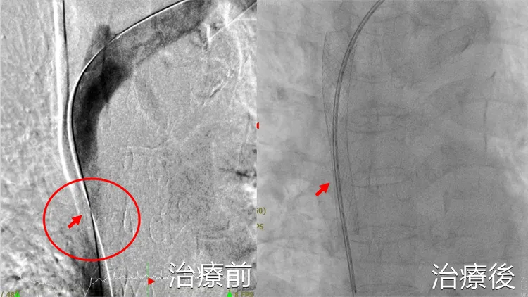 患者上腔大靜脈治療前後對照。院方提供