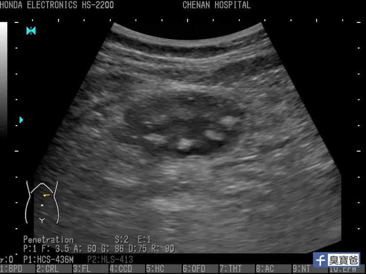 珍奶的珍珠（粉圓）到胃裡還是粒粒分明。翻攝臉書「臭寶爸 - 兒科陳敬倫醫師」