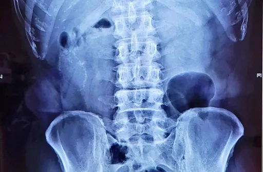 高雄大叔二天嗑3顆肉粽 吃到吐!檢查竟是這毛病住院六天康復