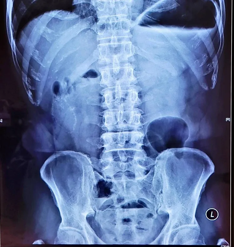 高雄這名大叔曾因腸子壞死部分切除，吃肉粽後腹痛住院六天。院方提供