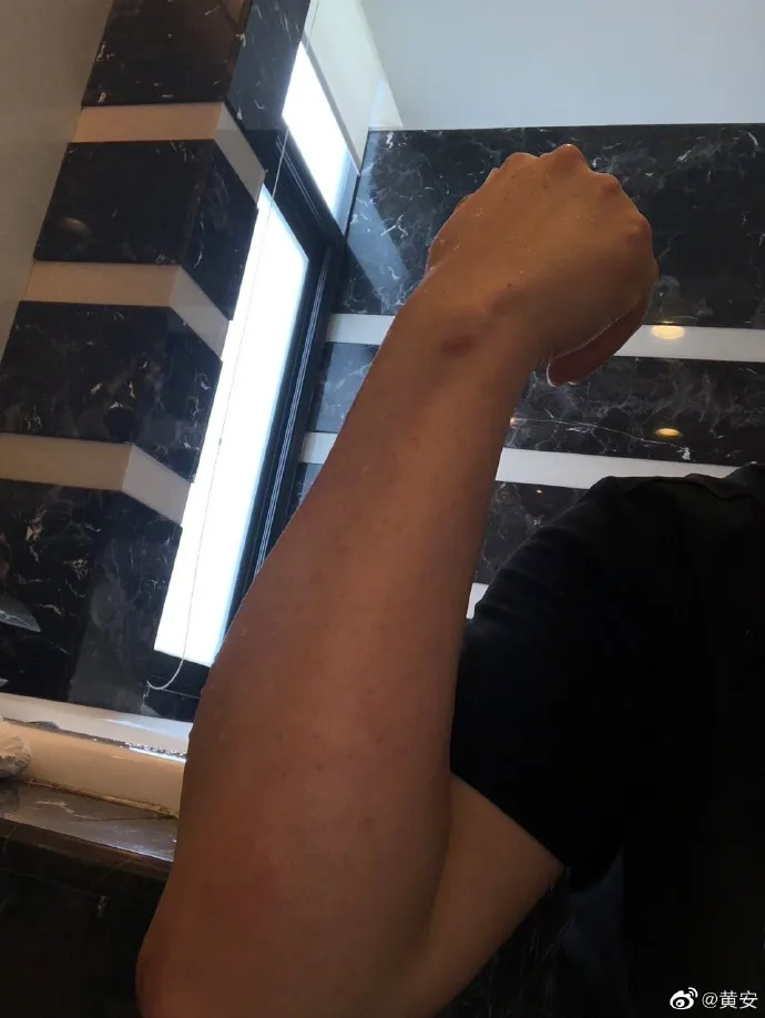 黃安的弟弟因為氣爆手臂灼傷。取自黃安微博