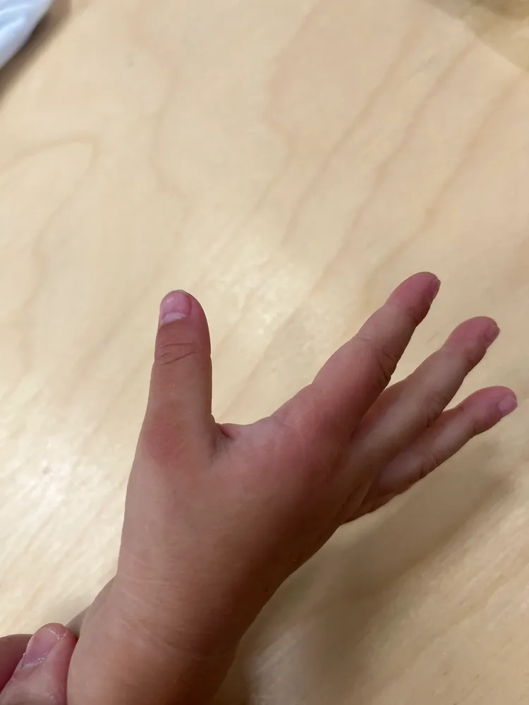 家長向議員投訴，老師夾傷孩子手，卻說謊反怪孩子。白喬茵提供