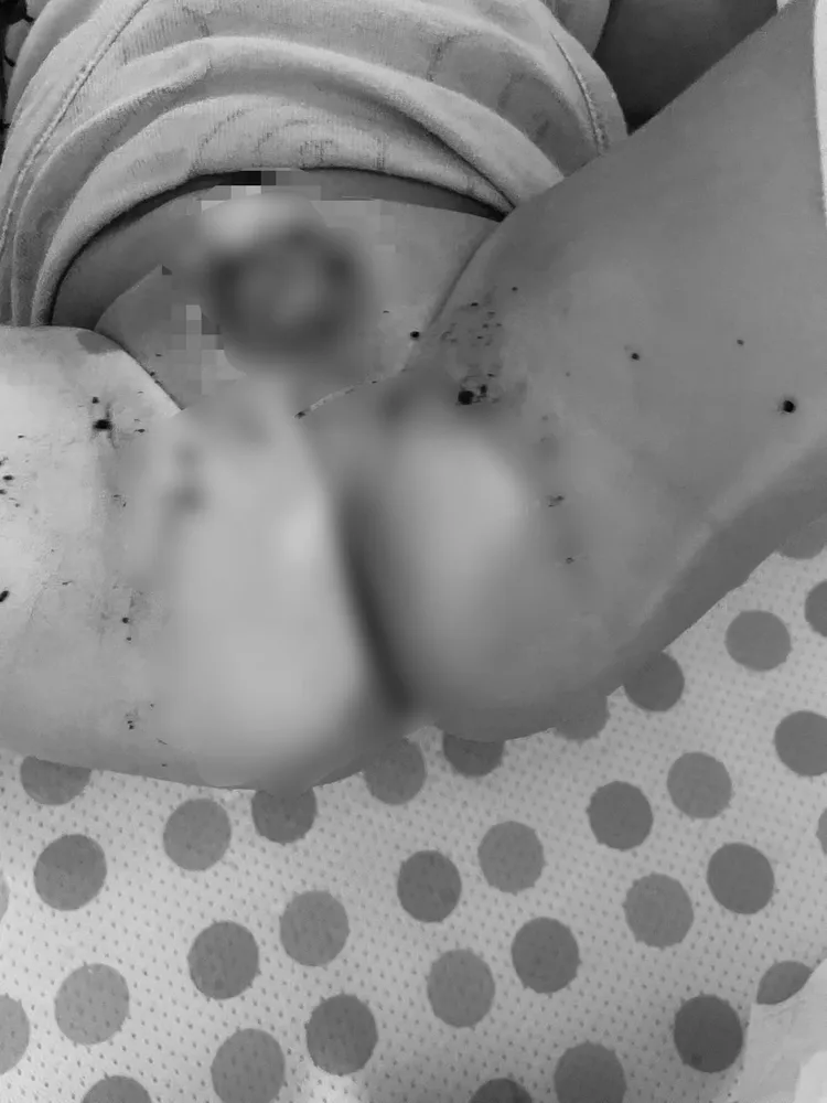 有嬰孩因托育人員疏失沒換尿布，生殖器、臀部紅腫。白喬茵提供