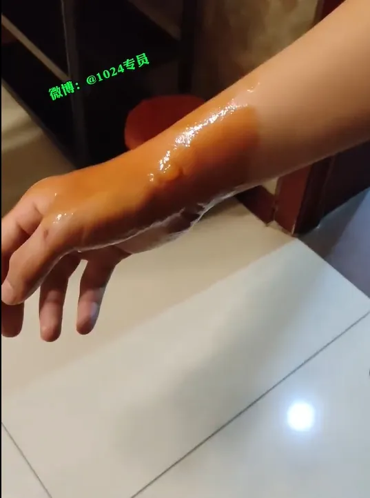 女童右手燙傷起水泡。取自微博