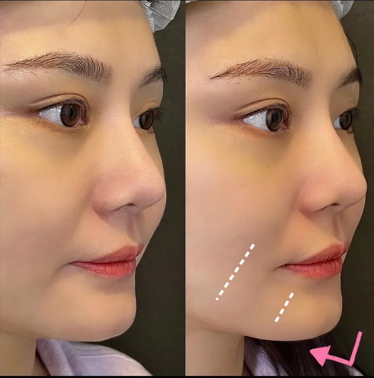 小薇做完音波拉提後明顯感覺木偶紋跟嘴邊肉的部分有得到改善，讓她臉上的老態全都消失無蹤！翻攝《小薇薇薇》的粉絲頁
