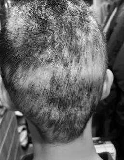 朱芯儀化療後落髮模樣。重版文化提供