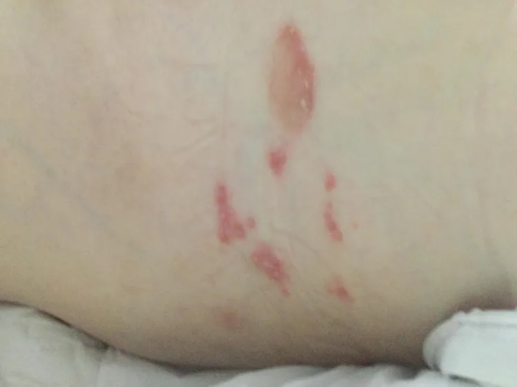 賴芳宇醫師提醒，若皮膚病灶未獲得妥善照護，可能引發細菌感染等併發症。院方提供