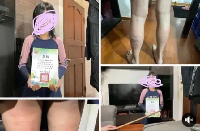 女童考第五名還遭父親持藤條抽小腿，腿上傷痕令網友不捨。取自爆廢二公社