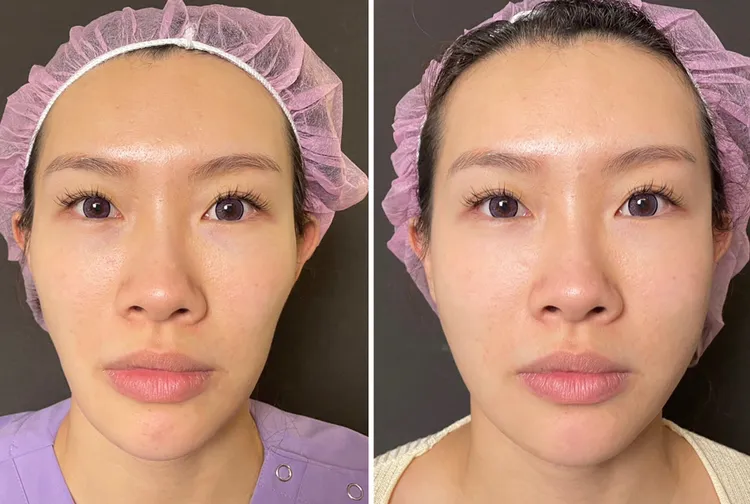 臉部膠原蛋白飽滿，整個人看起來更有活力。/ 圖片來源 : 愛爾麗診所提供見證，分享內容皆已取得當事人同意。