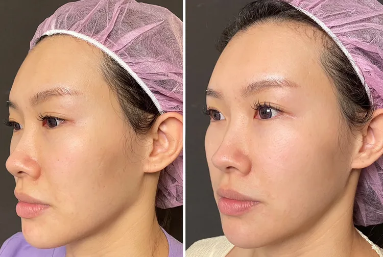 法令紋、木偶紋等紋路，是臉上最容易被看見的顯老症狀。/ 圖片來源 : 愛爾麗診所提供見證，分享內容皆已取得當事人同意。