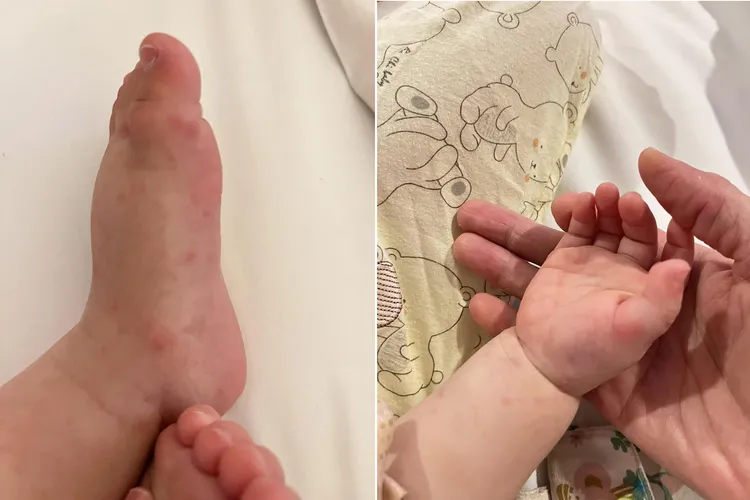 孩子身上起紅疹。取自李亮瑾臉書