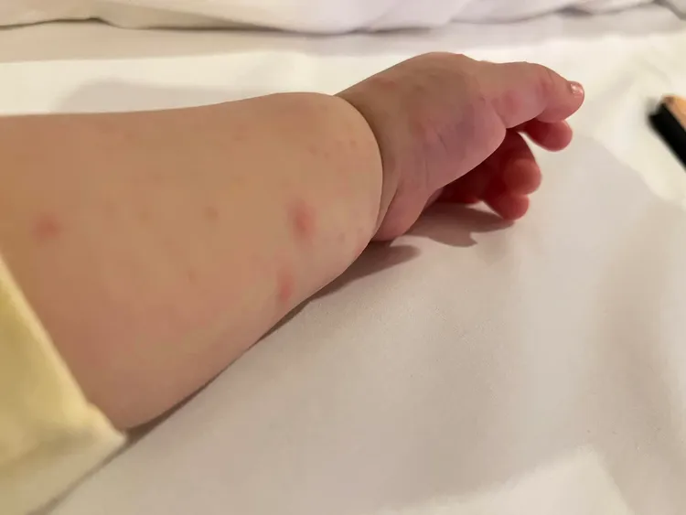 孩子身上起紅疹。取自李亮瑾臉書