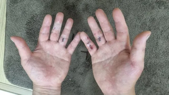 幸運從洪水中逃生的生還者，雙手都是緊抓欄杆磨出的傷痕。翻攝推特