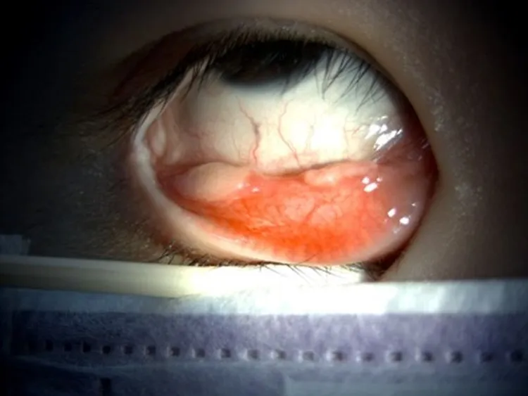 龍小弟右下結膜出現結節，被診斷罹患罕見的免疫球蛋白G4相關性疾病。院方提供