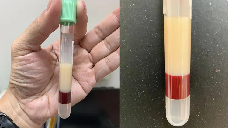 病人的血油油的！醫曝血油分離照。翻攝臉書「Icu醫生陳志金」