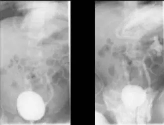 VCUG尿路逆流攝影看出左右兩側輸尿管都有逆流情況。翻攝畫面