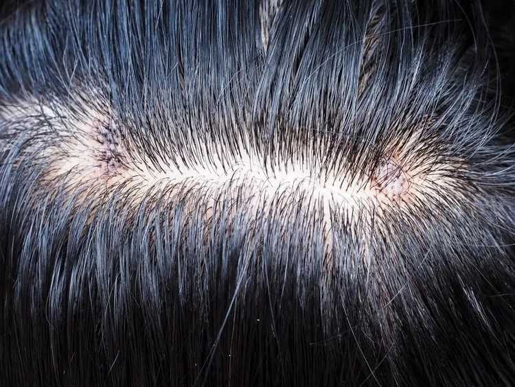 ▲皮膚科醫師指出，頭皮不健康，會影響毛囊生長。