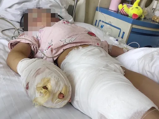 恶魔后母!逼童吃辣椒、手浸滚水 7岁女终身残疾