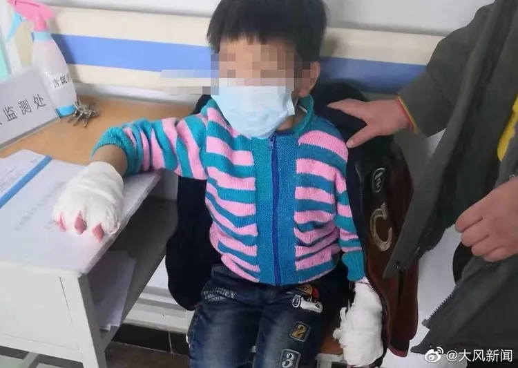 男童雙手都纏著紗布。翻攝微博