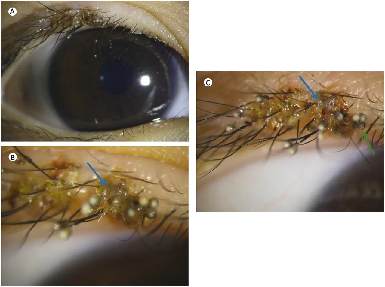 有圖！不洗手就揉眼睛3歲童睫毛爬滿蝨子｜壹蘋新聞網, image size:1280x956