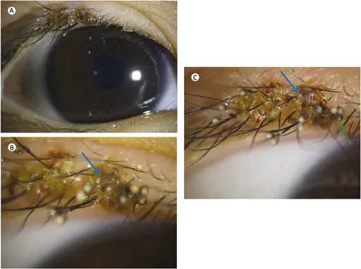 有圖!不洗手就揉眼睛 3歲童睫毛爬滿蝨子