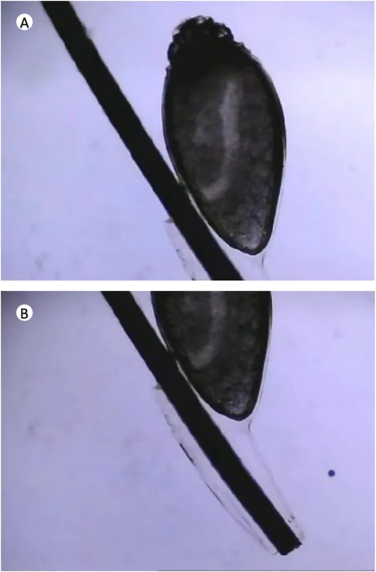 男童眼睫毛的蝨子卵。翻攝《美國眼科期刊病例報告》