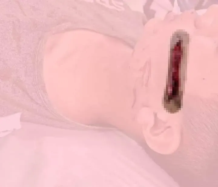 少年冤遭警抓！17針的傷口曝光。民眾提供