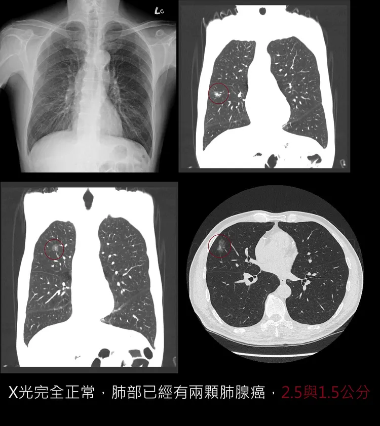 病患罹患肺腺癌，X光片卻顯示正常。取自蘇一峰臉書