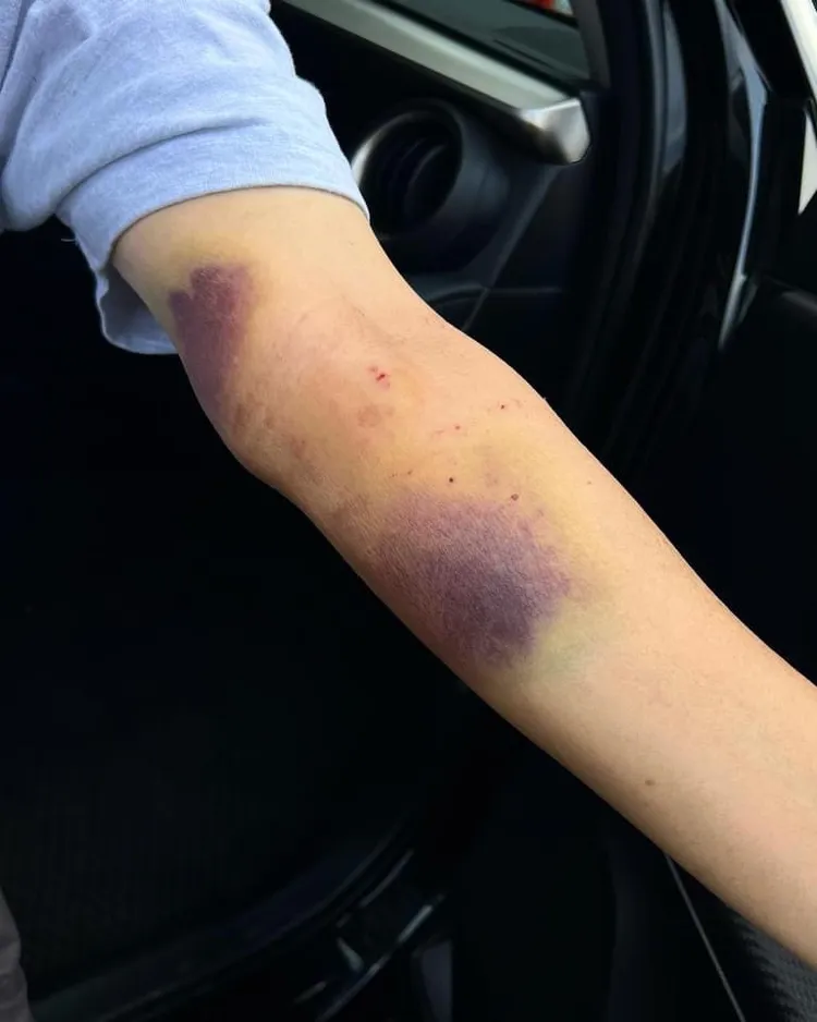 廖峻手上都是裝支架造成的瘀青。翻攝錦德臉書