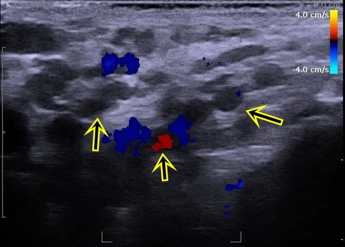 箭頭所指處即為精索靜脈屈張並血液亂流。院方提供