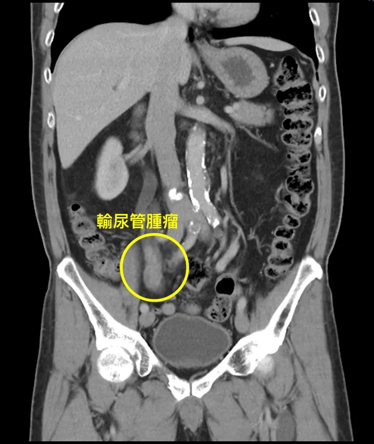 經檢查發現童先生右側輸尿管中段有明顯腫瘤。院方提供
