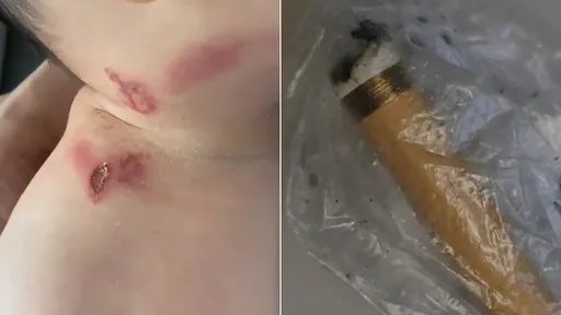 冒煙菸蒂亂彈「燙傷4月女嬰」 住戶都不認!恐全棟DNA比對揪兇