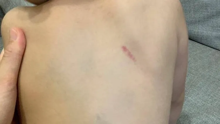 男童背部也有瘀傷。民眾提供