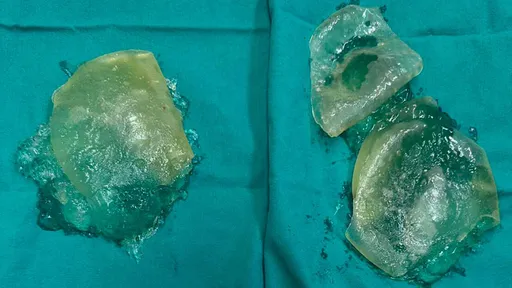 隆乳20年「假奶拿出來變這樣」 醫師提醒術後5年做這事