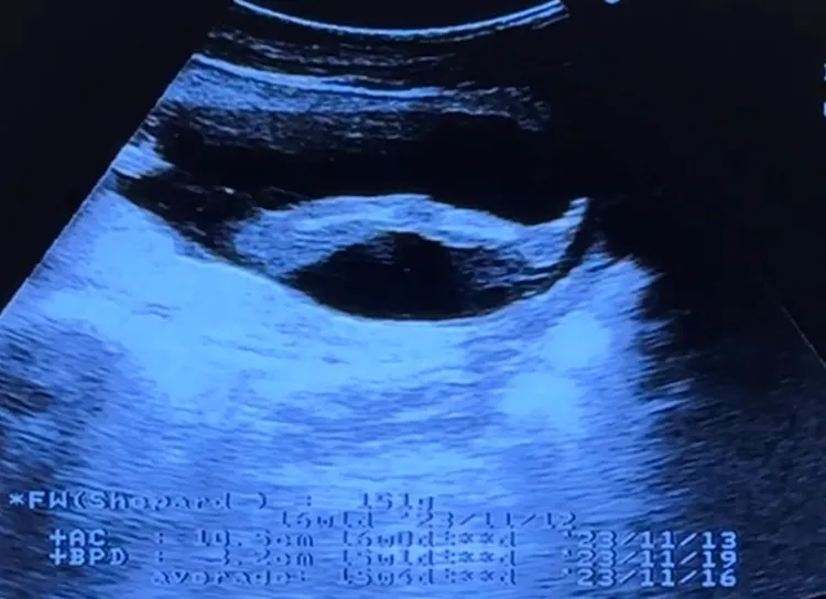 祈錦鈅超音波圖中顯見，是個長腿寶寶。本人提供