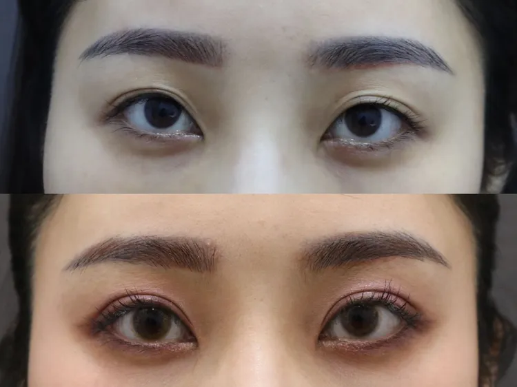 衛教示意圖，圖上為雙眼眼摺不對稱(俗稱大小眼)，圖下為對稱半開放式雙眼皮。