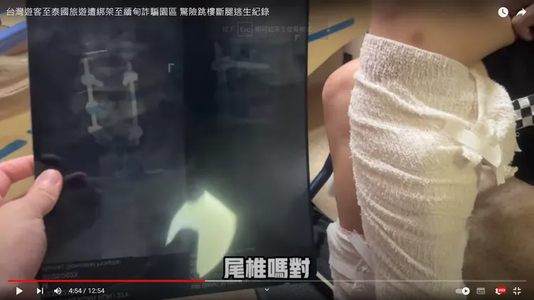 男子腰椎斷裂，X光片清晰可見動手術所安裝支架。翻攝自臉書「GASO全球反詐騙組織」