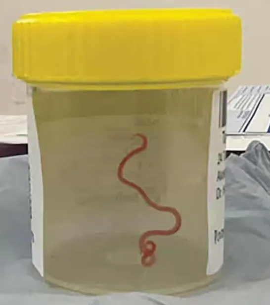 這隻活跳跳的蛔蟲長達8公分。翻攝Emerging Infectious Diseases